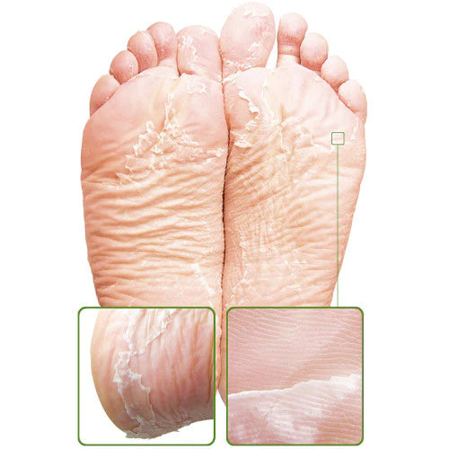Skin Sheek Sheeky Foot™ Exfoliating Foot Peel and Callus Remover