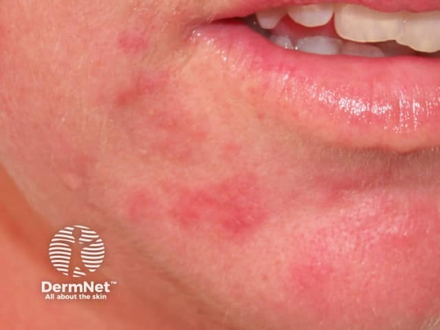 Perioral Dermatitis: What it is and how to help calm it